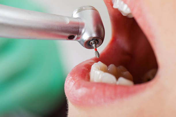 Best Chipped Tooth Repair Near Me  in Iceville, AL